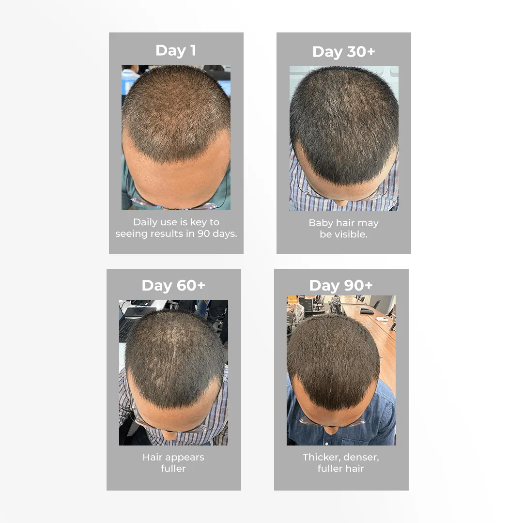 3% Redensyl & 4% Anagain Hair Growth Serum (Natural DHT Blocker)