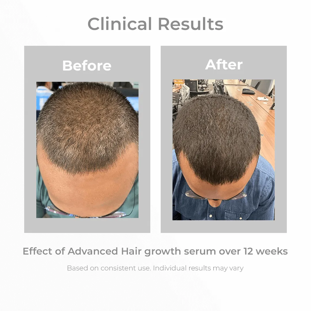 3% Redensyl & 4% Anagain Hair Growth Serum (Natural DHT Blocker)