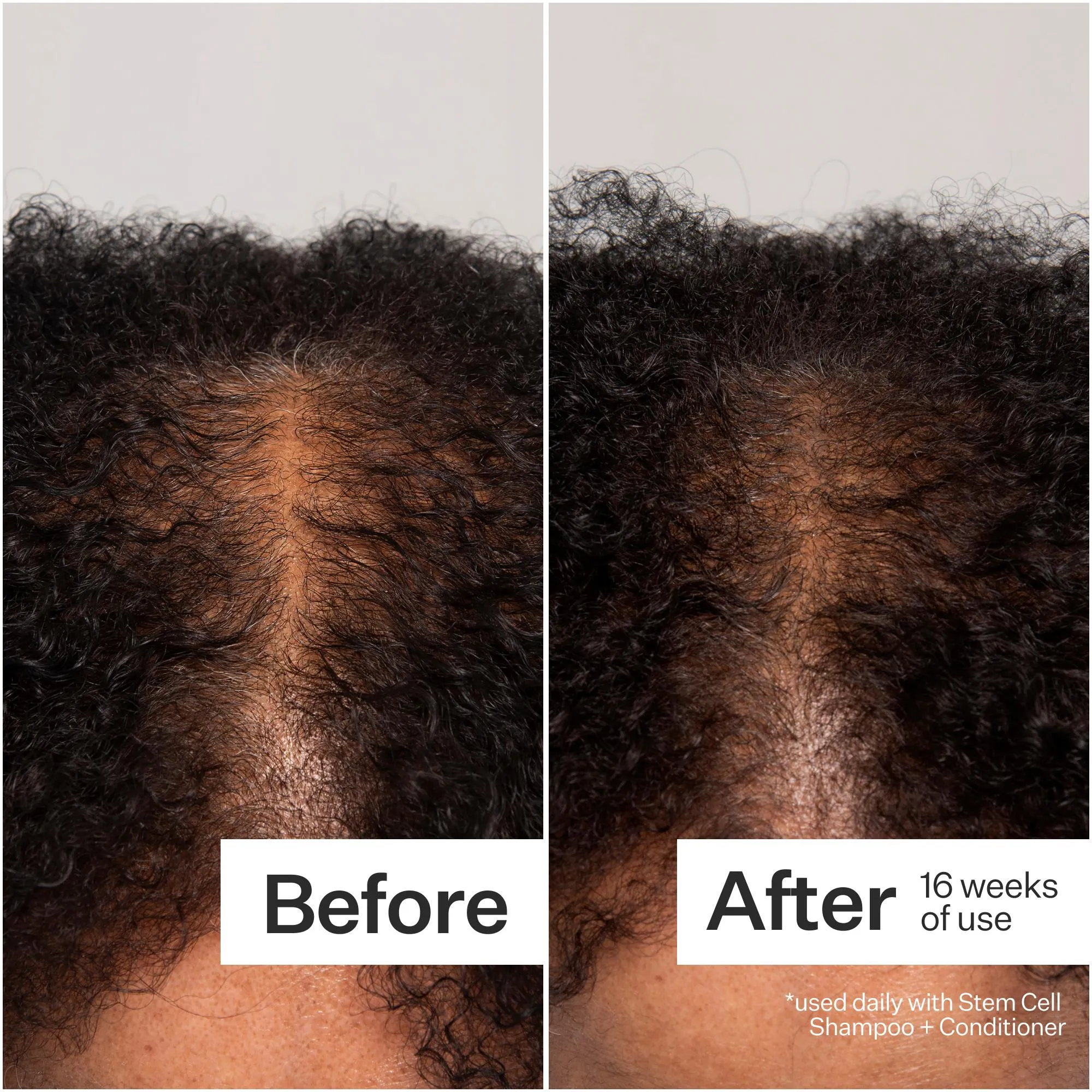 Act Acre 3% Stem Cell Peptide Treatment