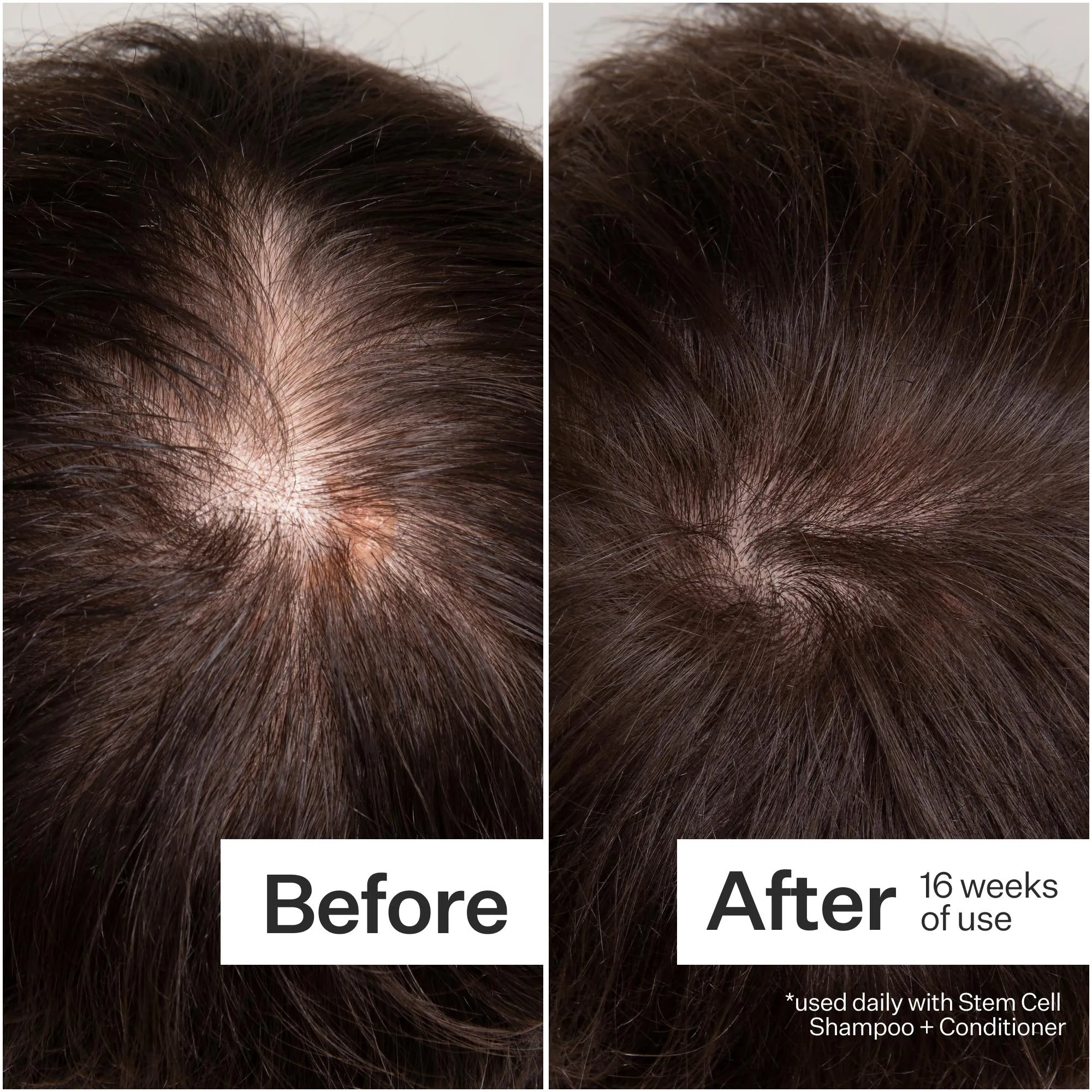 Act Acre 3% Stem Cell Peptide Treatment