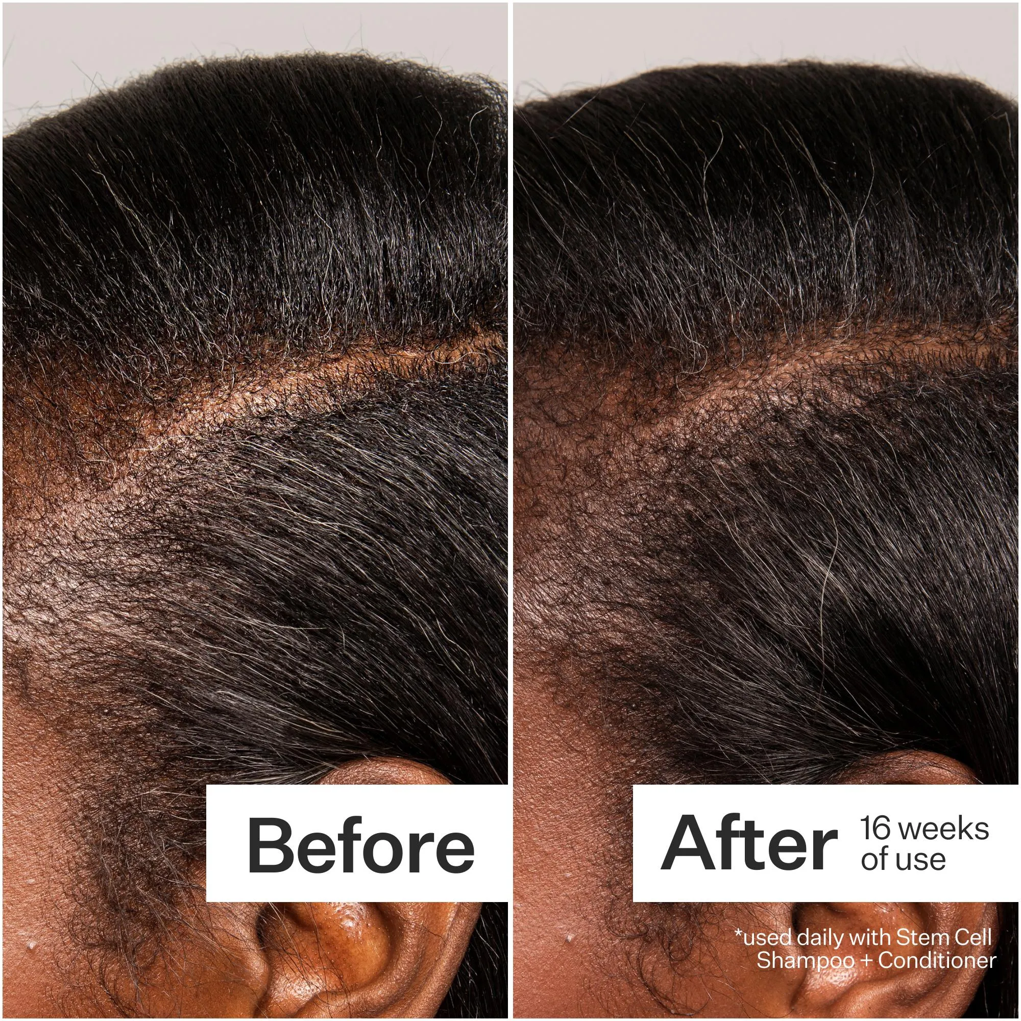 Act Acre 3% Stem Cell Peptide Treatment