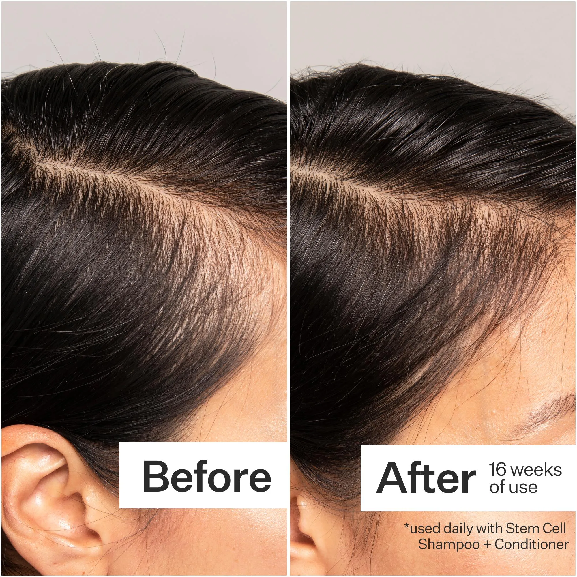 Act Acre 3% Stem Cell Peptide Treatment