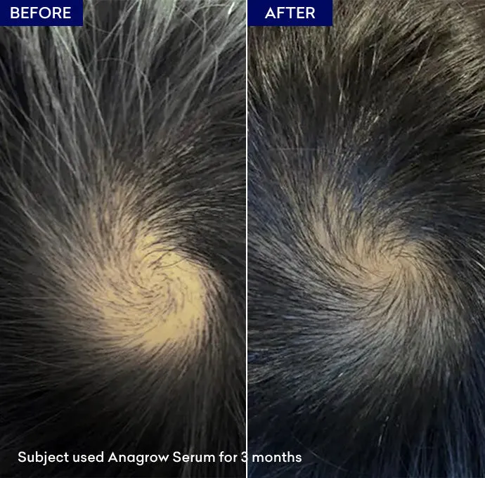 Anagrow Hair Serum