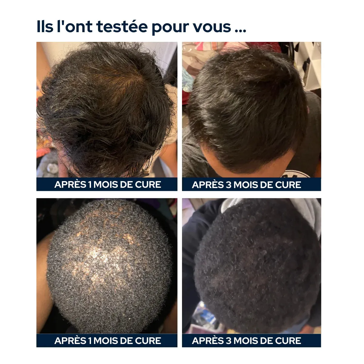 Complex Hair Loss Treatment for Men - 1 Month Cure by Epycure