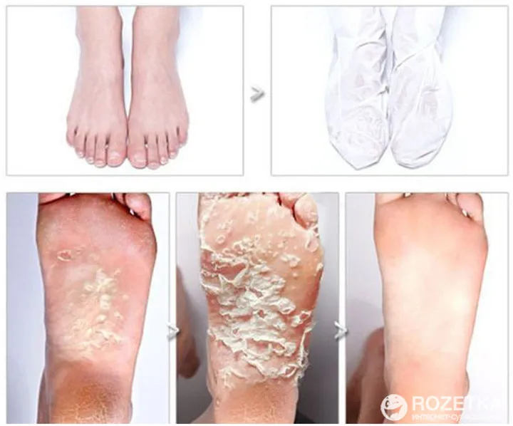 Foot Peeling Pack 1pcs